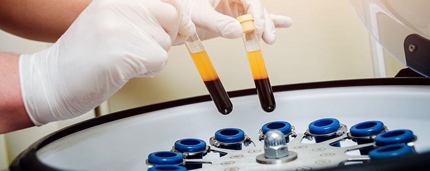 Platelet-Rich Plasma (PRP) Vienna